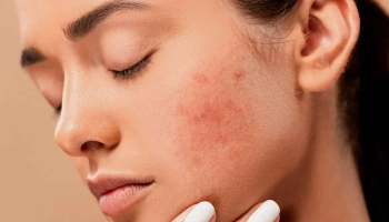 Осенние капризы кожи: почему так происходит и как помочь при атопии и аллергиях Осенние капризы кожи: почему так происходит и как помочь при атопии и аллергиях